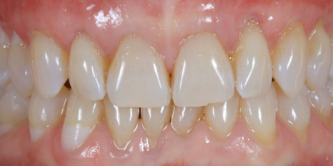 After image
