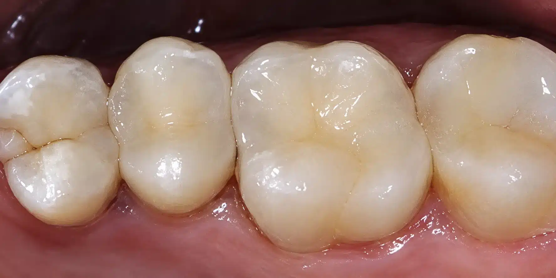 After tooth-coloured fillings at Cook Street Village Dental