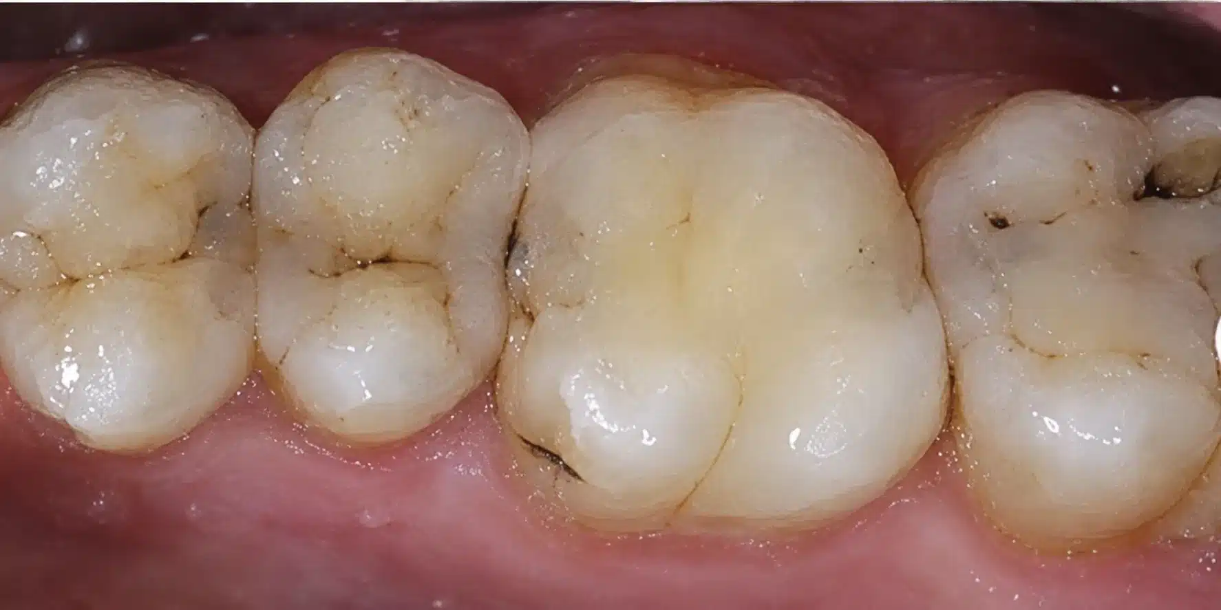 Before replacing old fillings at Cook Street Village Dental