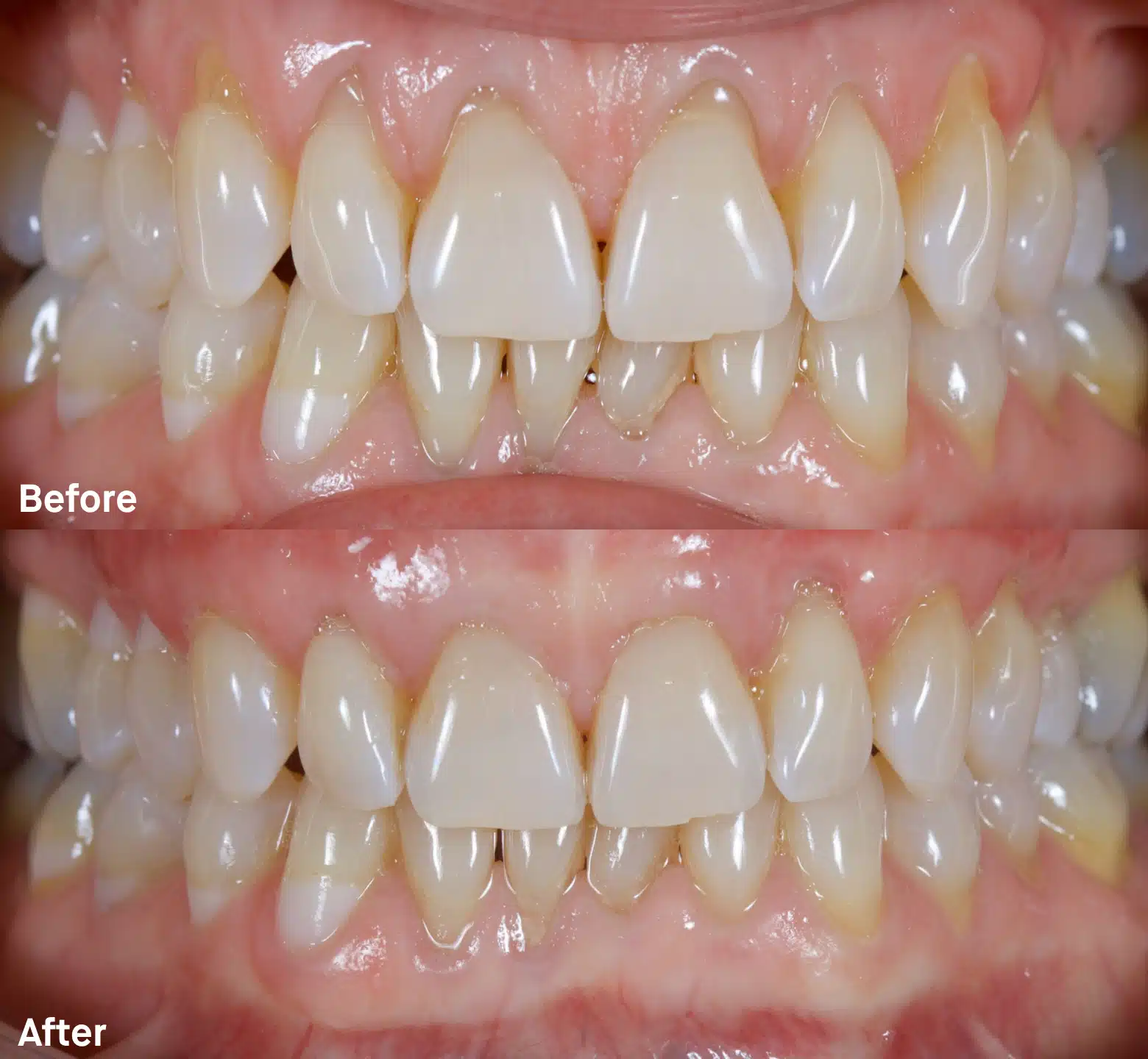 Before and after connective tissue gum graft at Cook Street Village Dental: exposed root on a lower front tooth after braces, covered with healthy gum tissue after grafting