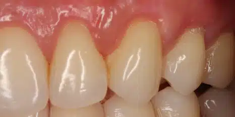 After image