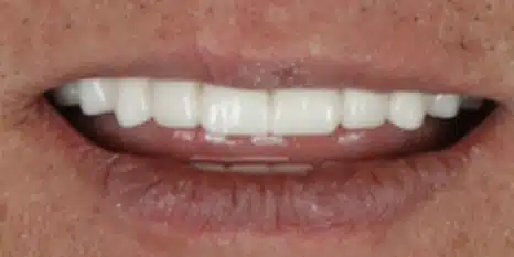 After All-on-X full arch dental implants at Cook Street Village Dental