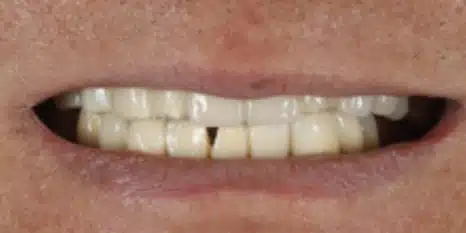 Before All-on-X full arch dental implants at Cook Street Village Dental