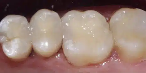 After tooth-coloured fillings at Cook Street Village Dental