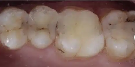Before replacing old fillings at Cook Street Village Dental