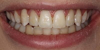 After image